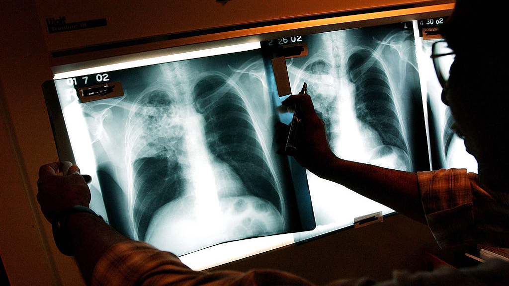2 active tuberculosis cases traced to San Francisco strip club — KTVU FOX 2 Bay Area, Monterey Health news